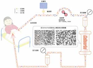 免疫吸附疗法.jpg 免疫吸附疗法.jpg